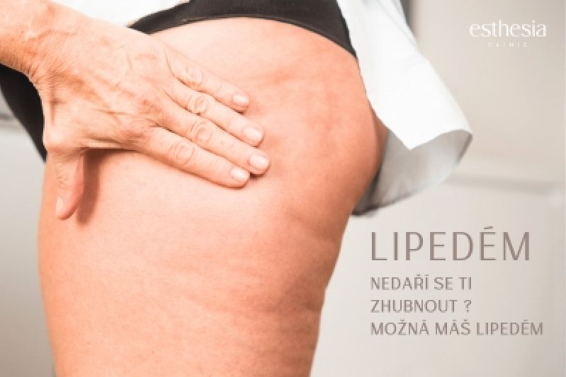 LIPEDÉM Diagnostika a léčba