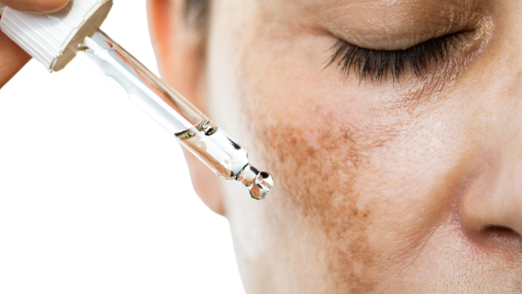 BLOG_esthesiaclinic_melasma_01_1120x630