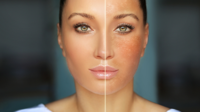 BLOG_esthesiaclinic_melasma_02_1120x630