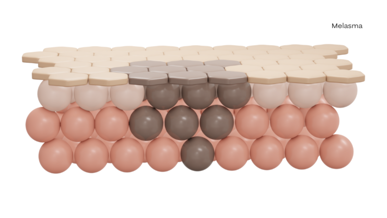 BLOG_esthesiaclinic_melasma_03_1120x630