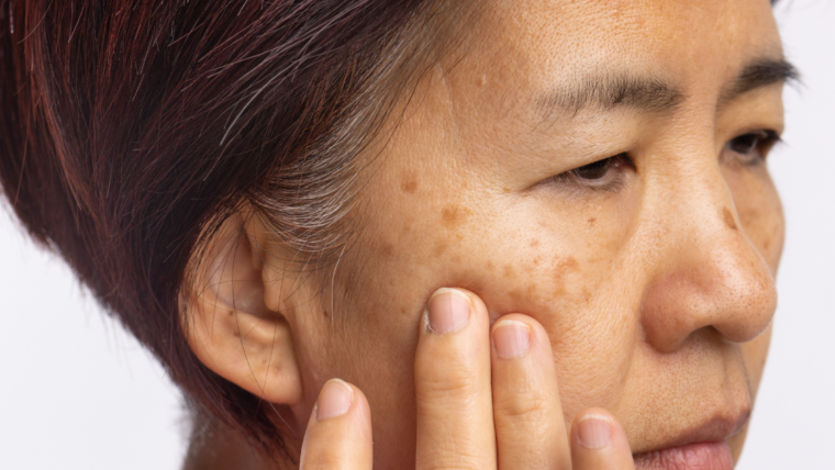 BLOG_esthesiaclinic_melasma_04_1120x630
