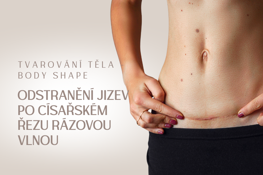 Odstranění jizev po císařském řezu rázovou vlnou