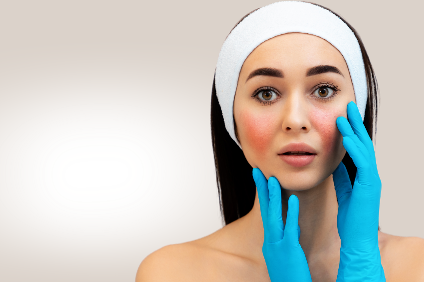 Rosacea a periorální dermatitida