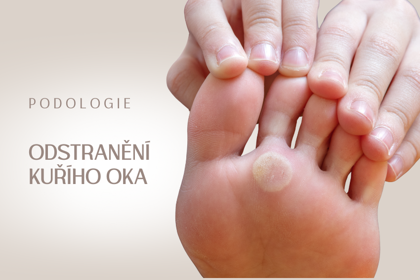 Odstranění kuřího oka