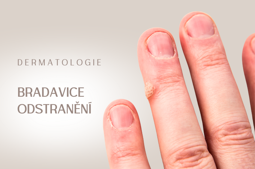 Bradavice – laserové a chirurgické odstranění